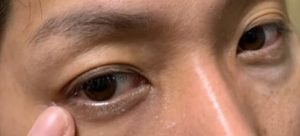 男の目の周りの黒ずみは解消出来る 黒ずみに特化した改善方法 しろむログ
